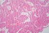 Hepatocellular_Carcinoma_(7205111796)