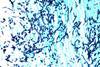 Candidiasis (1)