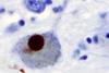 Lewy_Body_alphaSynuclein