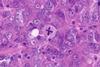 Pathologic_mitosis