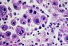 Cytomegalovirus_infection_-_Case_301_(35104826390)