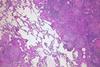 Pulmonary_tuberculosis_(6545189731)