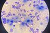 Chlamydia-22Feb25