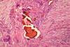 Fecal_matter_foreign_body