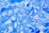 Mycobacterium_tuberculosis_Ziehl-Neelsen_stain_640
