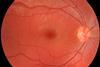 Fundus_photograph_of_normal_right_eye