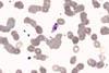 Plasmodium_falciparum_malaria,_1000x