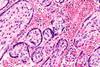 Maternal_malaria_placenta_-_very_high_mag