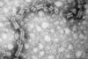 Mumps_virus_electron_micrograph