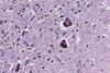 Eosinophilic_inclusions_parkinson_HE