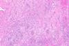 960px-Kidney_with_chronic_inflammation_and_fibrosis_--_low_mag