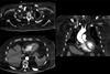 Ausgepraegte_fettige_Muskelatrophie_bei_amyotropher_Lateralsklerose_78M_-_CT_-_001