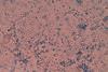 Malassezia_in_LPCB_Tease_Mount_Microscopy