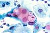 800px-Pap_smear_showing_clamydia_in_the_vacuoles_500x_H&E