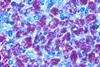 Lymph_node_-_Atypical_mycobacterial_infection_(MAI)_4