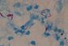 Acid_fast_bacilli_of_Mycobacterium_tuberculosis