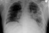 XR_chest_-_pneumonia_with_abscess_and_caverns_-_d0