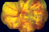 PMID20029144_05_progressive_outer_retinal_necrosis_-_cracked_mud