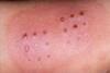 Réaction_inflammatoire_BCG_lors_maladie_de_kawasaki