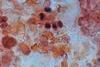 Pneumococcus_in_Gram-Stained_BAL_Sample