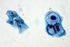 ThinPrep_Pap_smear_HPV