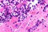 Small_cell_carcinoma_infected_with_herpes_simplex_virus_-_Case_260_(8540530672)