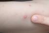 Chickenpox_blister_2006.01.06