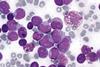 Myeloid_leukemia