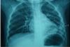 Pneumonia_and_pleural_effusions_on_the_lower_left_lung_(2.5_y.o._child)