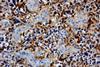 Glioblastoma_GFAP