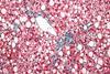 960px-Non-alcoholic_fatty_liver_disease1