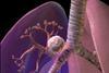 Blausen_0619_LungCancer