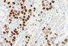 Consistent_with_HPV-associated_SCC_-_p40_--_high_mag