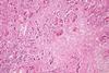 Histopathology_of_massive_hepatic_necrosis_in_hepatitis_B