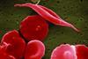 Sickle_cells_illustration