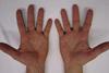 Characteristic_rash_of_hand,_foot,_and_mouth_disease,_on_human_hands