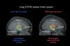 Low-Res_Covid-patient_brain-image