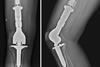Knee_arthroplasty_due_to_a_chondrosarcoma_2