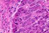 Mitosis_in_a_neuroendocrine_tumor_(original)