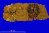 Colorectal adenocarcinoma human