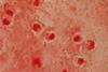 Gram_negative_coccobacilli_of_Acinetobacter_in_bronchoalveolar_lavage_(BAL)_Gram_staining