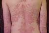 Psoriasis_on_back1