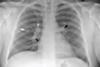 Chest_X-ray_of_discrete_round_nodules_after_secondary_tuberculosis
