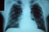 Pneumonia_x_ray