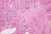 Histopathology_of_massive_hepatic_necrosis_in_hepatitis_B (1)