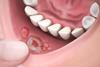 Stomatitis