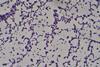 Staphylococcus_aureus_Gram_stain