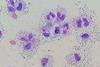 Cerebrospinal_fluid_differential_in_bacterial_meningitis_-_Wright-Giemsa_stain