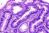 960px-Colon_adenoma_(1)