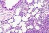 pulmonary_fibrosis-m-1140x760